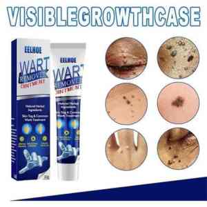Wart Remover Fast Acting Gel Wart Remover Freeze Off - Fast-Acting Wart Ointment